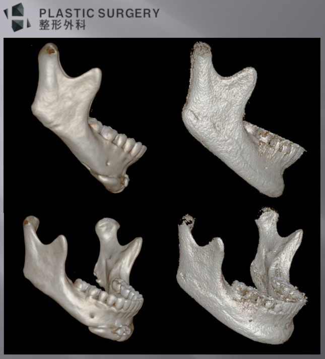 사각턱·턱끝 재건 수술 전후 정면 얼굴과 3D CT 비교