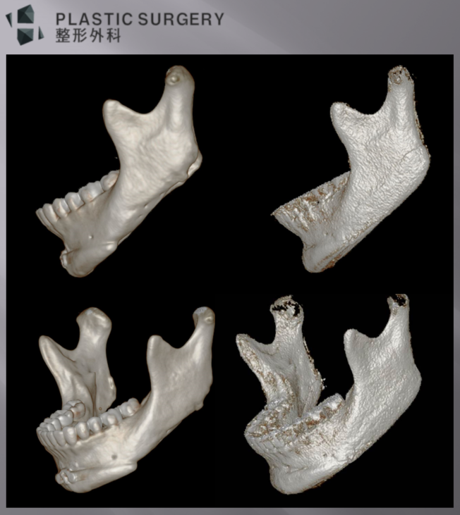 좌우 하악각·하악체부·T절골 계단 현상 재건 전후 3D CT