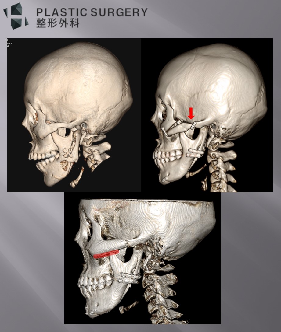 광대 체부와 광대활의 연결 상태를 분석한 3D CT