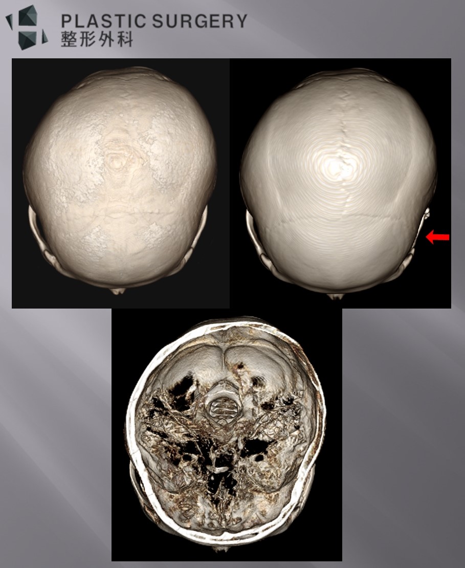 광대축소술 후 함몰과 보형물 재건 결과를 비교한 좌측면 3D CT