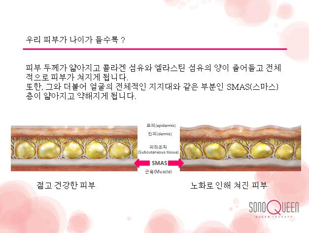 퀸테라피 이미지