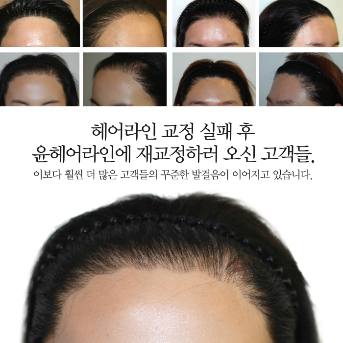 진헤어라인 이미지