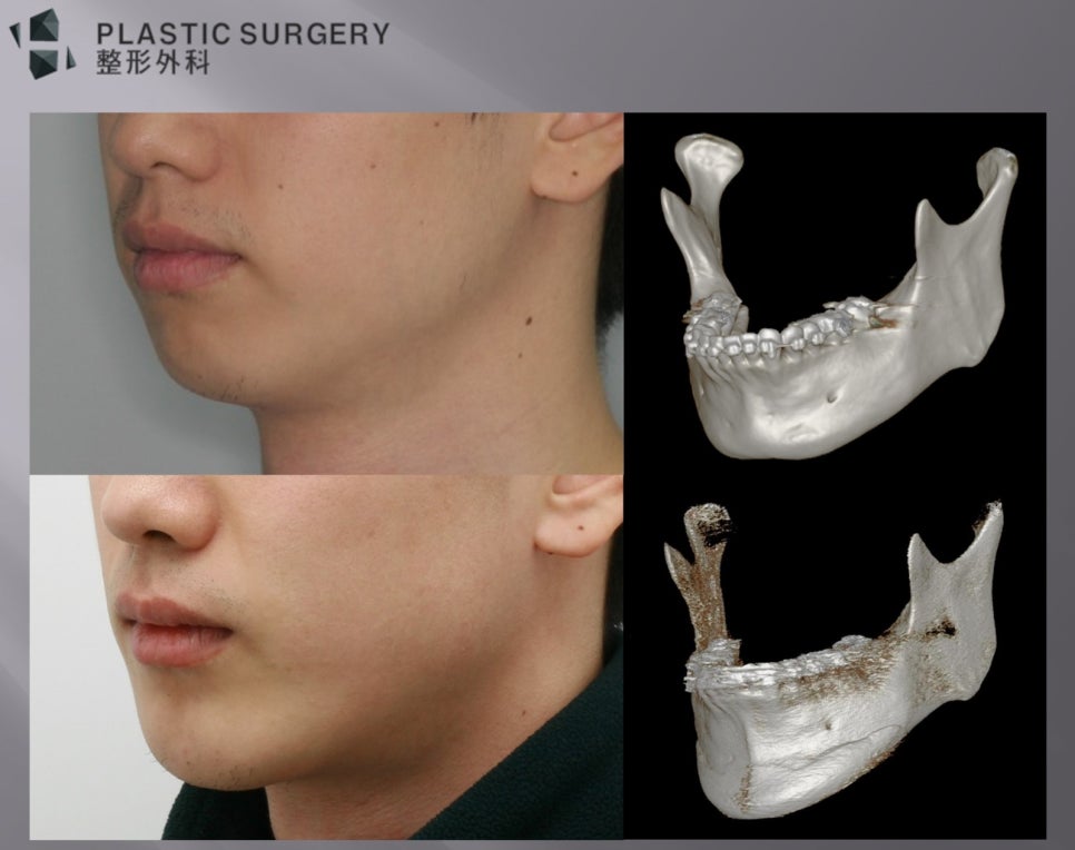턱끝과 하악체부를 연결한 3D Fit 보형물 대안 설계