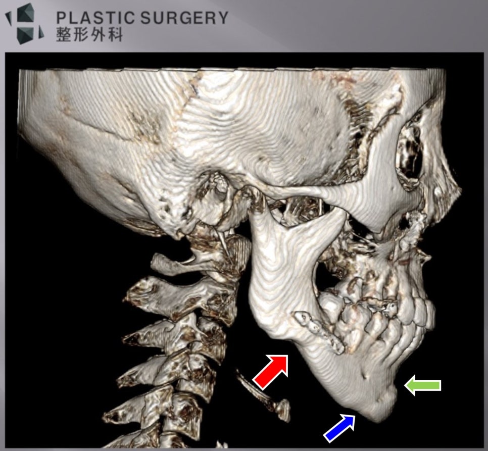 양악수술과 ㅅ자 턱끝 전진술 후 골흡수·계단 현상 3D CT