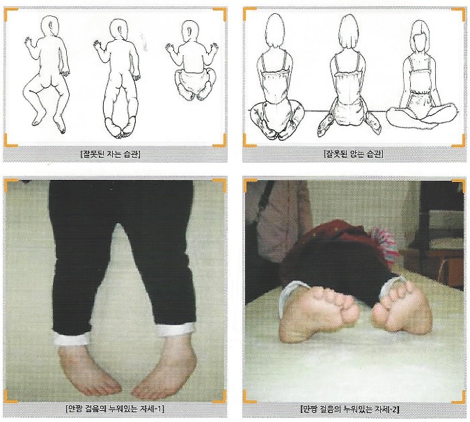 안짱걸음, 안짱다리, 휜 다리 소아 경골 염전 : 네이버 블로그 안짱걸음, 안짱다리, 휜 다리 소아 경골 염전 : 네이버 블로그