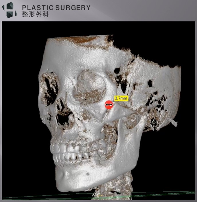 광대수술 후 3~4mm 절골면 간격이 보이는 3D CT