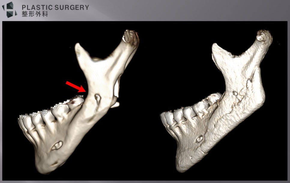 노출된 신경관 주변 재건 전후 좌측면 3D CT