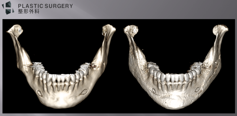 하치조신경관 노출 환자의 사각턱 재건 전후 정면 3D CT
