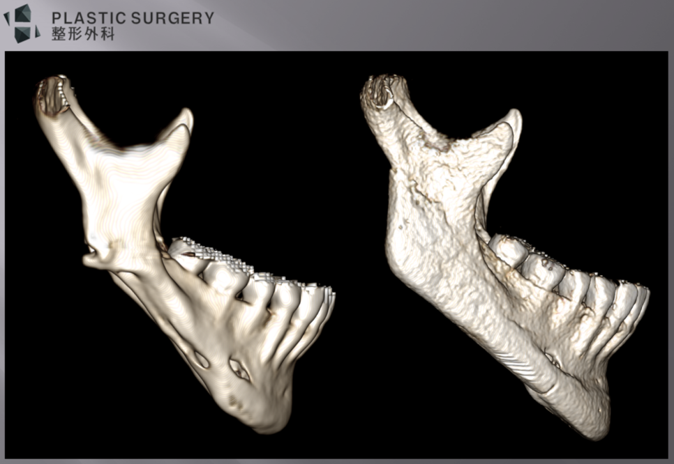 과절제된 하악각과 하악체부 재건 전후 우측면 3D CT