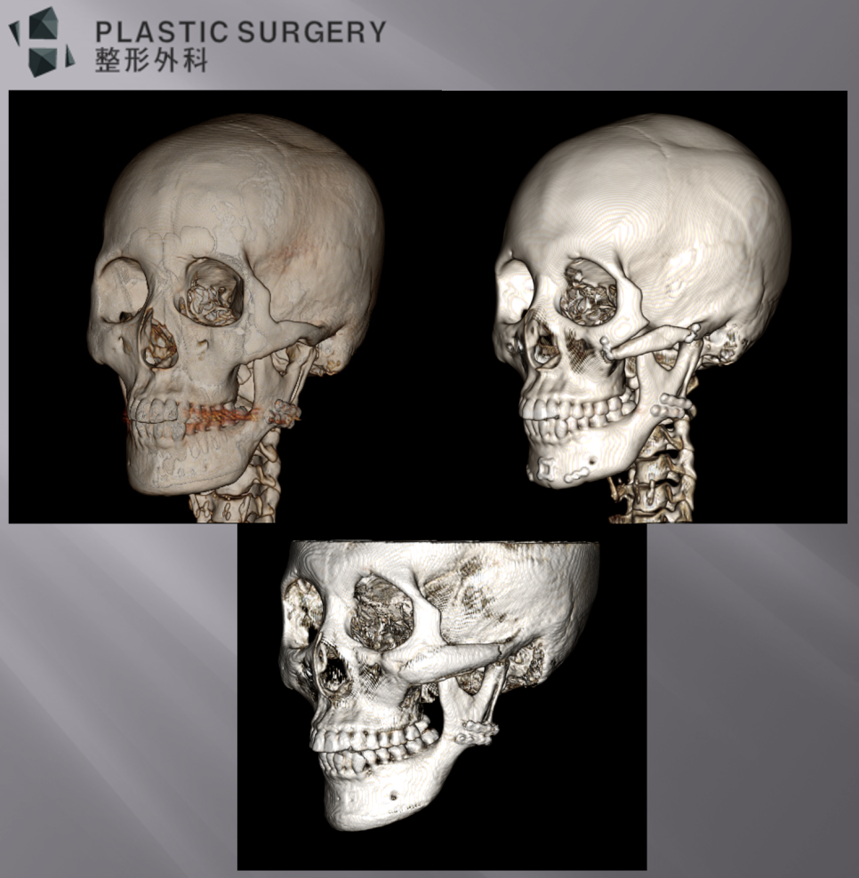광대와 턱끝 재건 전후를 비교한 좌사면 3D CT