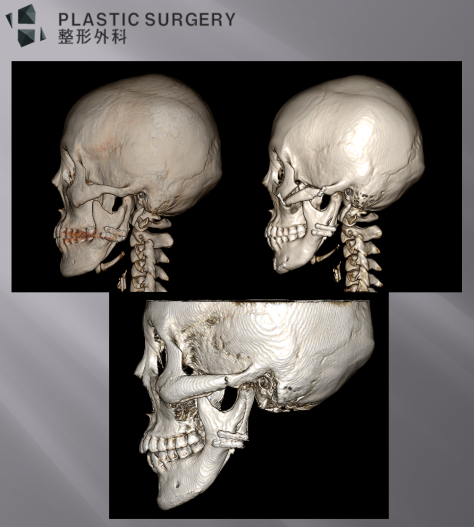 턱끝 재건 전후를 비교한 좌측면 3D CT