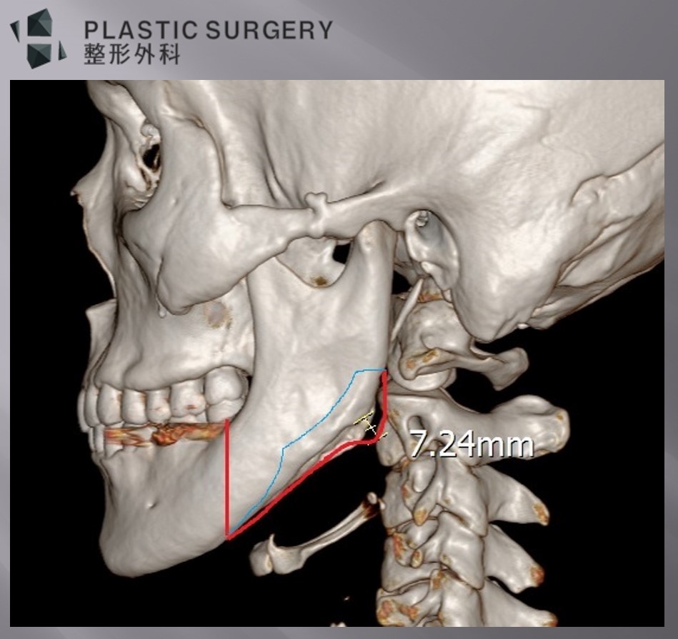 우측 자가골과 좌측 보형물로 하악각을 재건한 사례의 3D CT