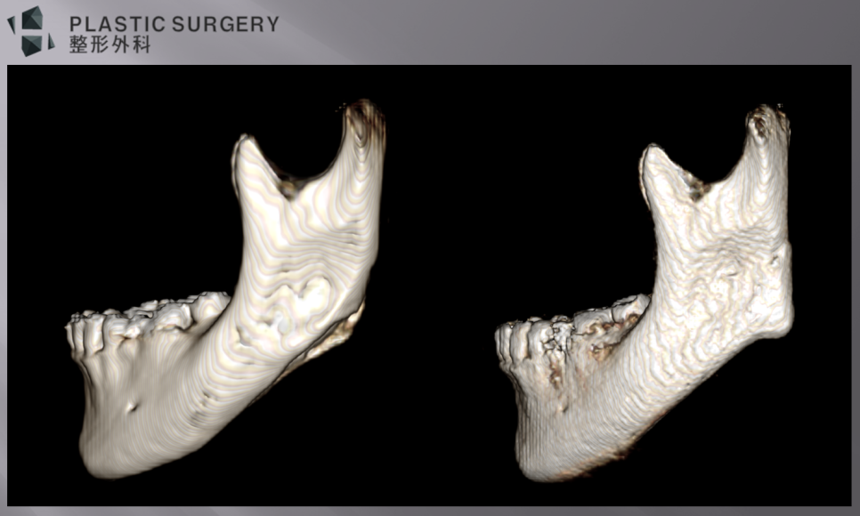 정면 효과를 최소화한 하악각 재건 전후 정면 3D CT