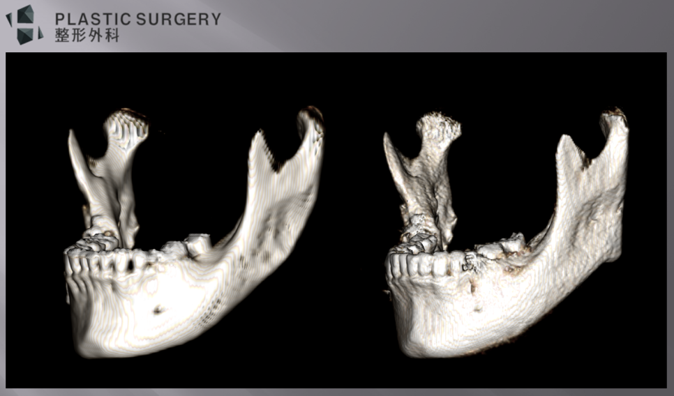자가골과 보형물로 만든 하악각을 비교한 측면 3D CT