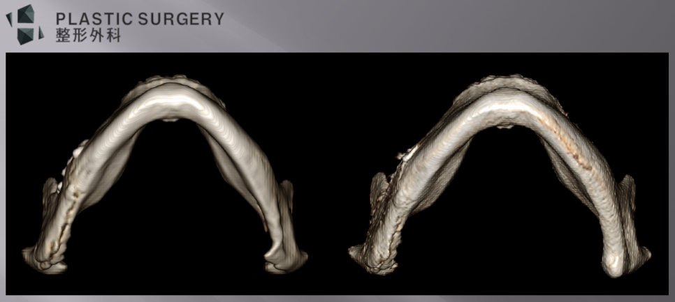 하악각만 만들고 피질골 재건을 최소화한 좌사면 3D CT