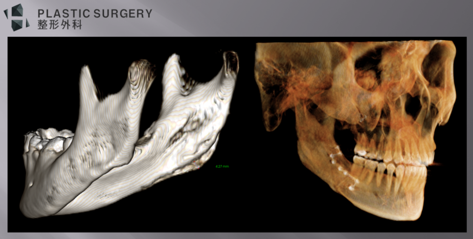 자가골 하악각의 약 4~5mm 재건량을 후면과 투영 영상으로 확인한 3D CT