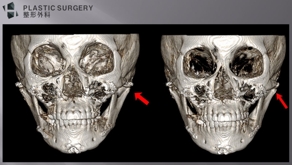 광대 과교정 환자의 플레이트 위치와 광대활 상태를 확인한 3D CT