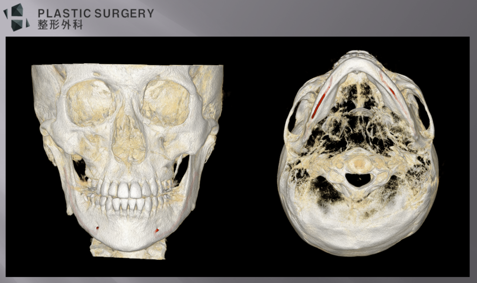 사각턱 과절제 후 좌우 하치조신경관 노출 정도를 비교한 정면 3D CT