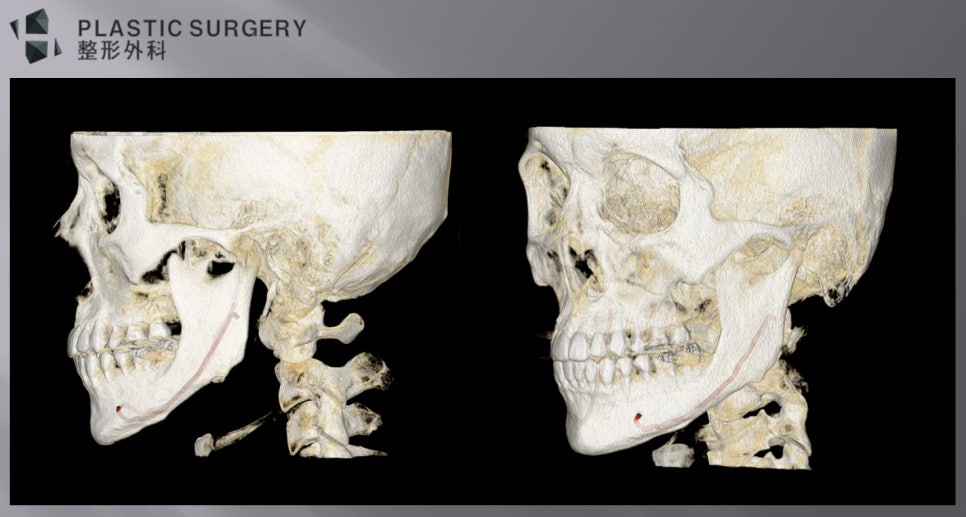 좌측 하치조신경관이 뼈 안에 위치한 상태를 확인한 측면 3D CT