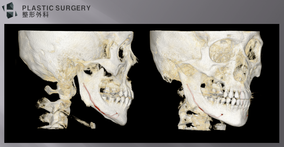우측 하악체부 밖으로 노출된 하치조신경관을 확인한 측면 3D CT
