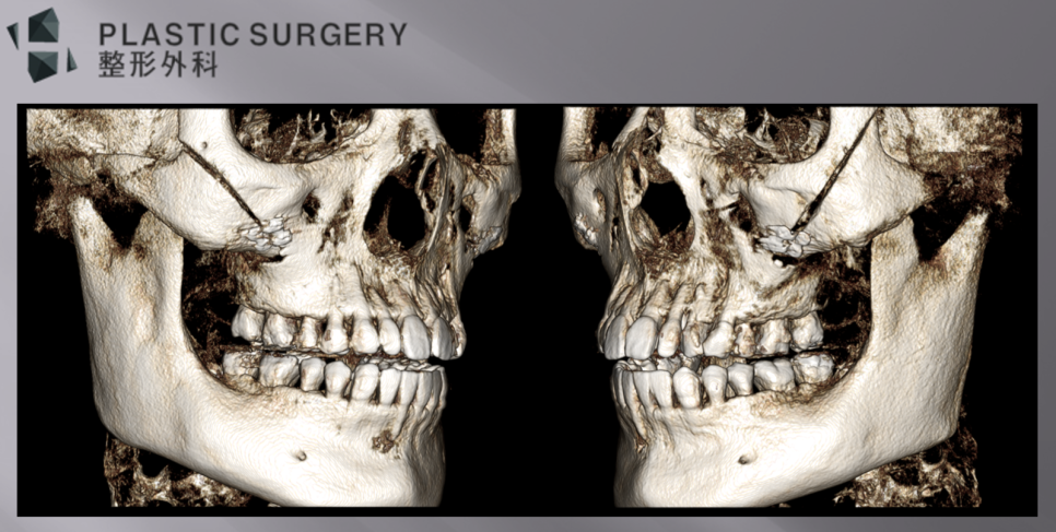 광대갭 없이 고정된 좌우 광대 체부를 비교한 사면 3D CT