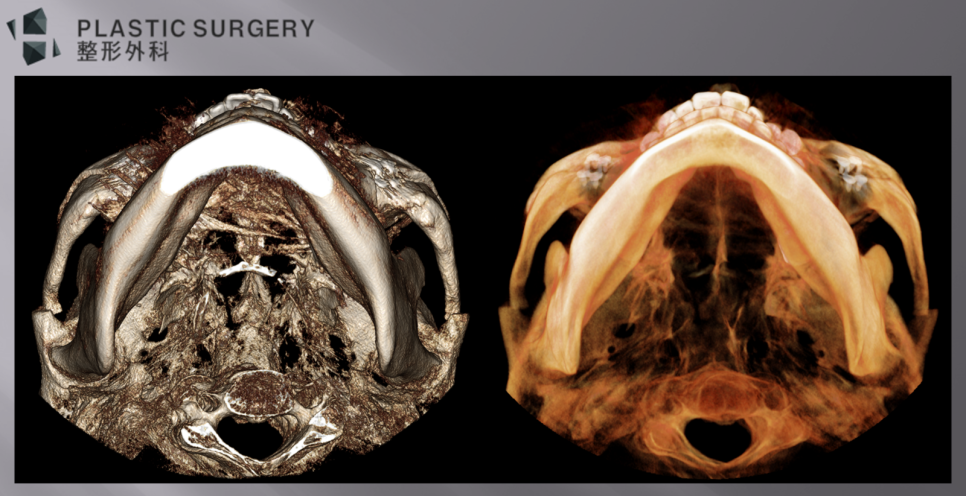 옆광대 축소와 Bone Z plasty 형태를 확인한 광대활 3D CT