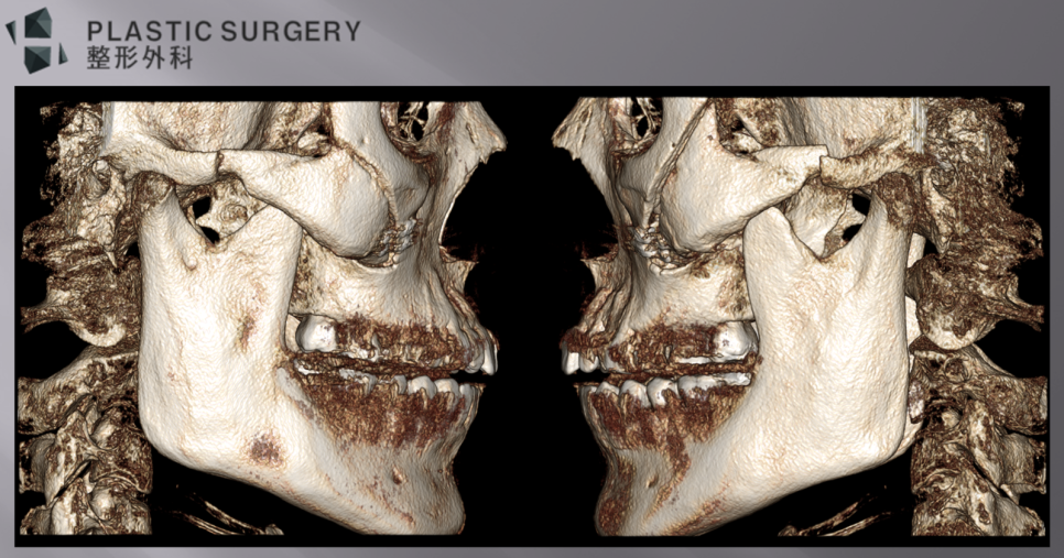 좌우 광대활 절골선과 상방 이동을 비교한 측면 3D CT