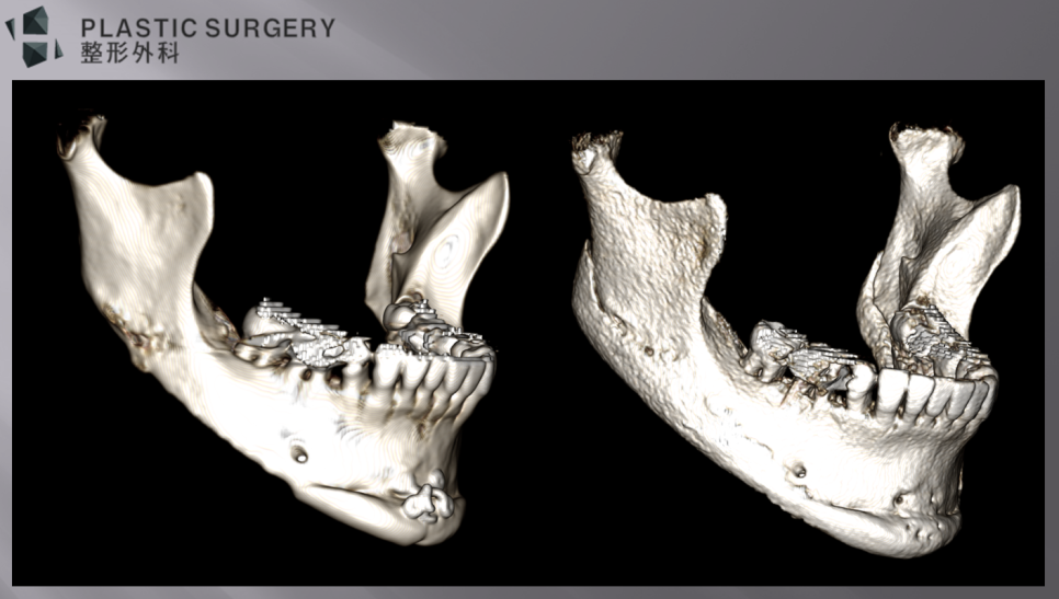 하악을 후방으로 배치해 비대칭을 개선한 우측면 3D CT