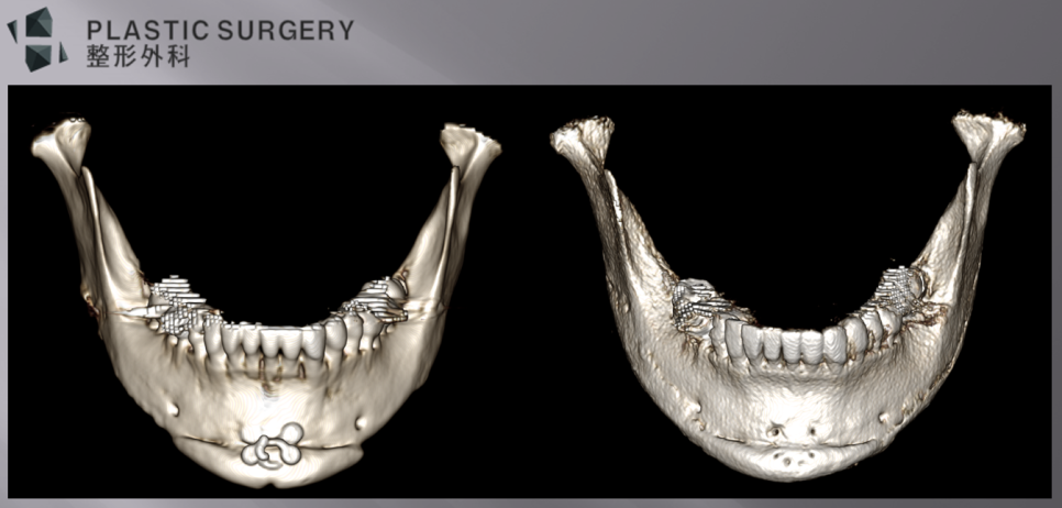 사각턱 재건과 턱끝 비대칭 교정 전후 정면 3D CT