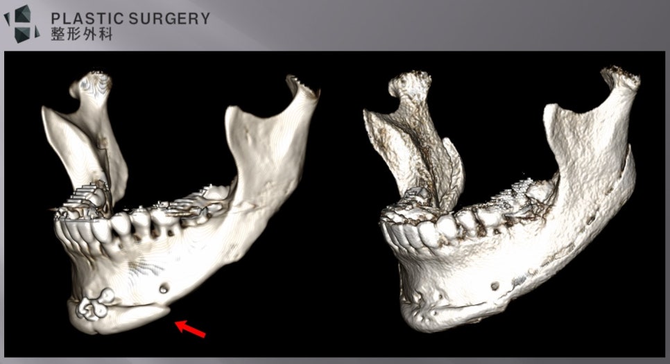 하악각·하악체부 보형물과 턱끝 비대칭 삭제 부위를 표시한 좌측면 3D CT