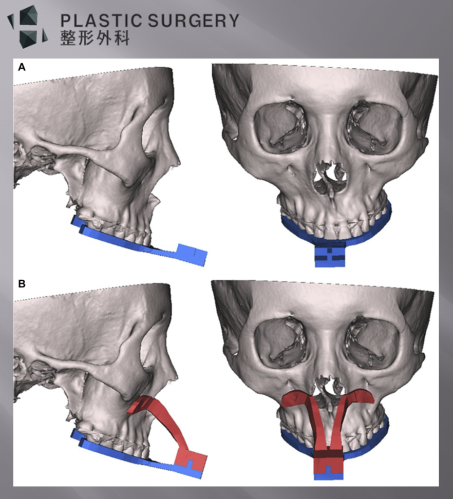 3D 프린팅 인공턱 이식 사례: 맞춤형 티타늄 하악 재건 - 논문에 소개된 수술 전 가이드 제작 이미지 입니다. 상악 웨이퍼와 절골라인 가이드가 결합되어 정확한 수술을 계획하고,