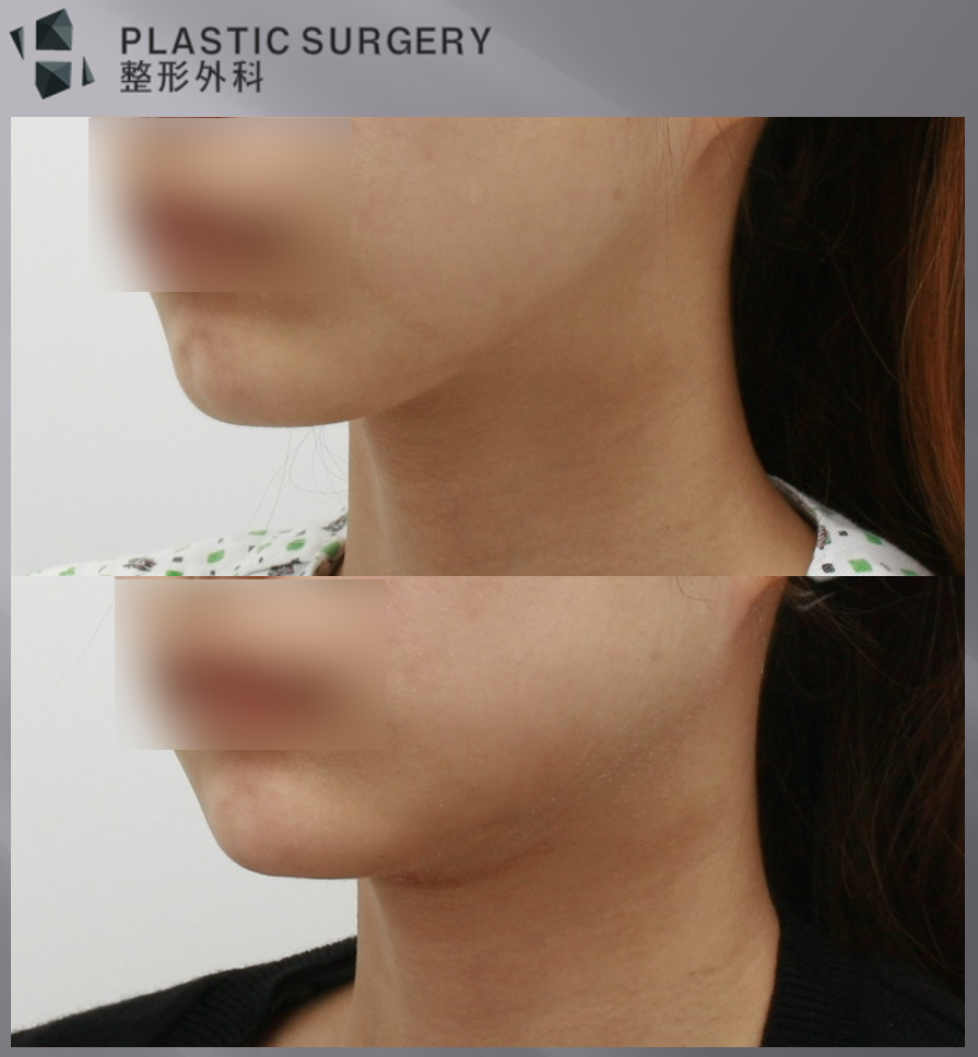 사각턱 과절제 후 개턱 재건: 하악각 복원 사례와 회복 과정 - 사면 모습 입니다. 아직은 부기가 있는 모습이지만, 하악각이 없어 개턱처럼 보이는 모습은