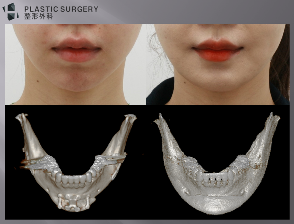 광대·사각턱 재건의 3차원 분석: 3D CT와 피부 스캔 중첩 - 이 경우 하악이 짧고 폭이 좁은 상태가 되면, 위 사진처럼 보형물을 통한 재건수술로