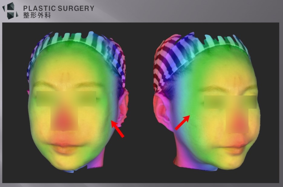 광대·사각턱 재건의 3차원 분석: 3D CT와 피부 스캔 중첩 - 3D 스캐너로 피부 굴곡을 스캔해서 돌출 정도를 색으로 표현한 이미지 입니다. 왼쪽 광대 부위는 굴곡이 보이는 반면,