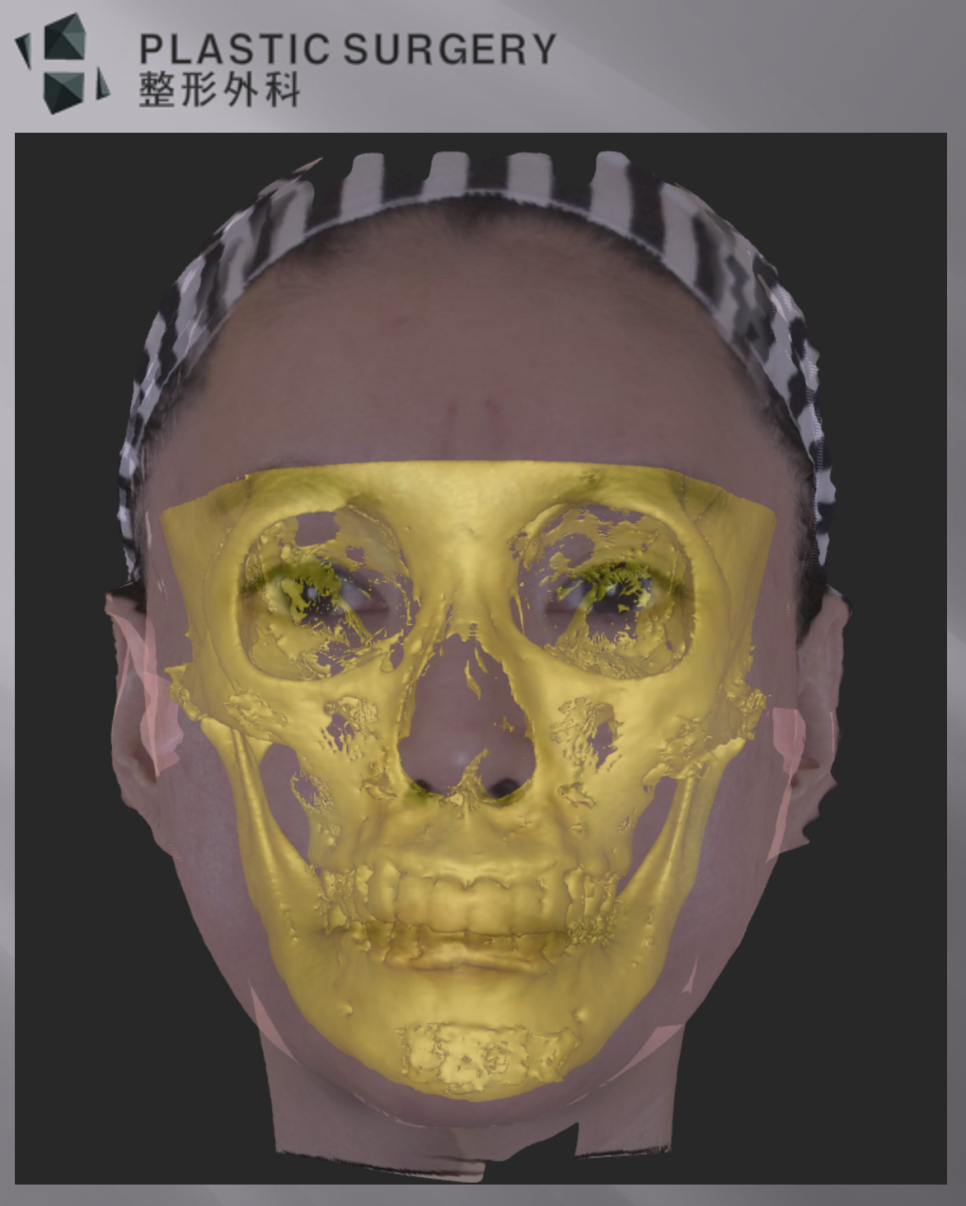광대·사각턱 재건의 3차원 분석: 3D CT와 피부 스캔 중첩 - 환자의 피부 3D 스캔 이미지와 3D CT 이미지를 중첩시킨 모습입니다.