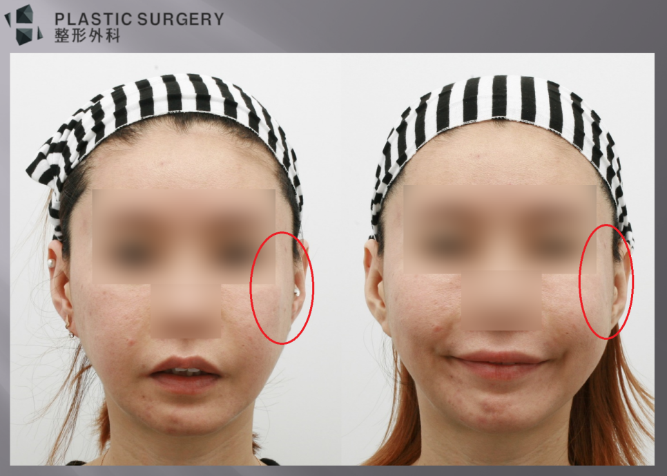 광대·사각턱 재건의 3차원 분석: 3D CT와 피부 스캔 중첩 - 정면 모습에서 빨간 원부위의 함몰과 계단 현상이 관찰 됩니다. 우측 사진 처럼 미소를 지을때 볼살이 위로 뭉치면서