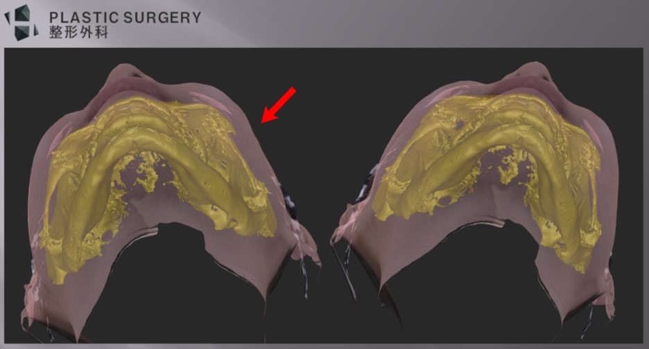 광대·사각턱 재건의 3차원 분석: 3D CT와 피부 스캔 중첩 - 실제 피부 스캔 데이터와 3D CT 스캔 데이터를 중첩시킨 이미지에서 위 화살표 부위처럼