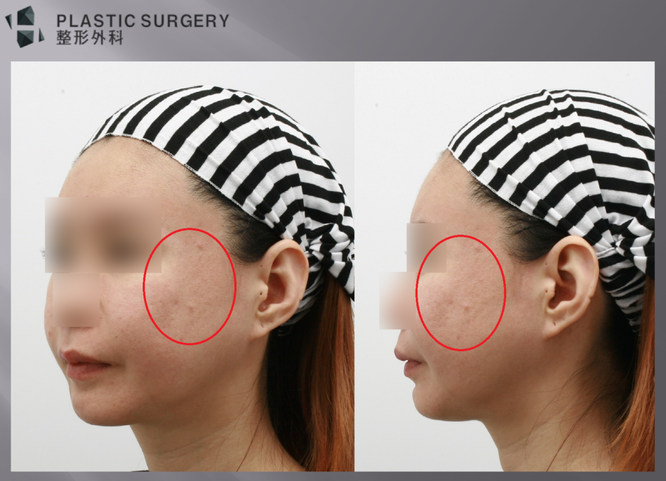 광대·사각턱 재건의 3차원 분석: 3D CT와 피부 스캔 중첩 - 측면과 사면 사진에서 보면, 광대 부위에 사선으로 함몰이 발생한 모습을 볼 수 있습니다.