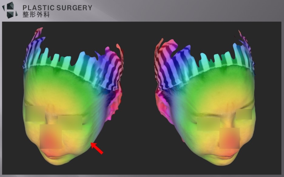 광대·사각턱 재건의 3차원 분석: 3D CT와 피부 스캔 중첩 - 각도를 조금 달리해서 보면, 좌측 광대는 사선으로 함몰과 계단 현상이 관찰되는 반면, 우측 광대는