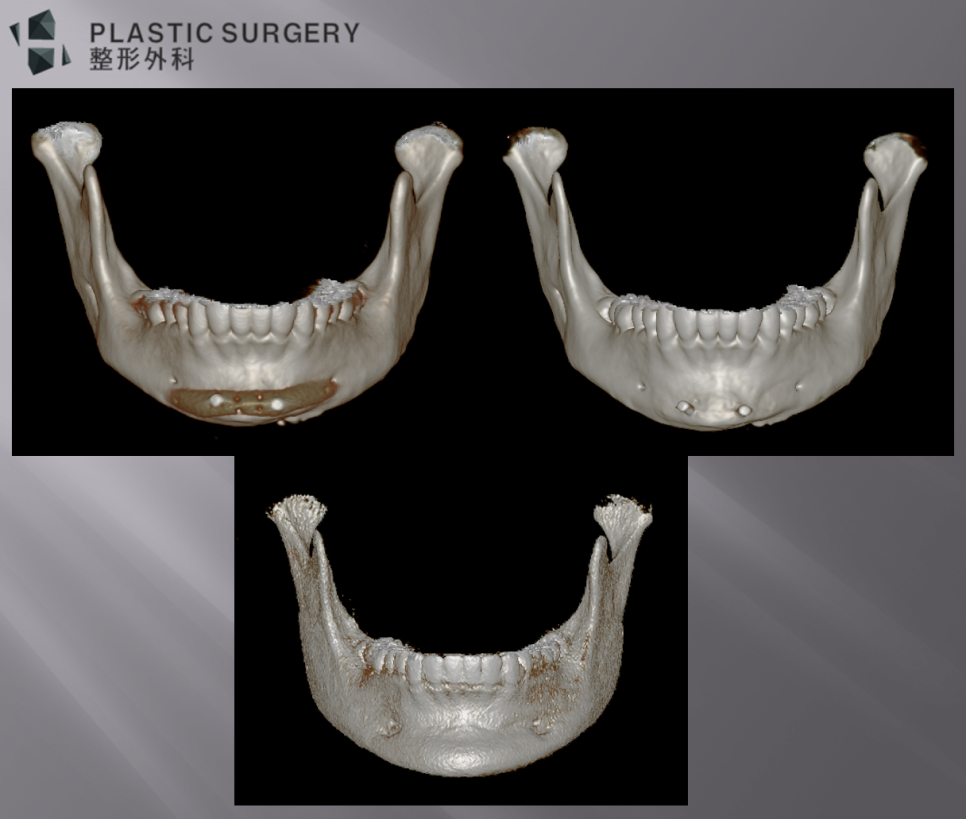 사각턱·턱끝 재건과 턱끝 보형물: 3D Fit PMMA 수술 사례 - 위 사진은 위쪽의 수술 전 보형물이 삽입된 모습과 보형물이 제거된 모습, 3DFit PMMA 보형물로 재건된 모습입니다.