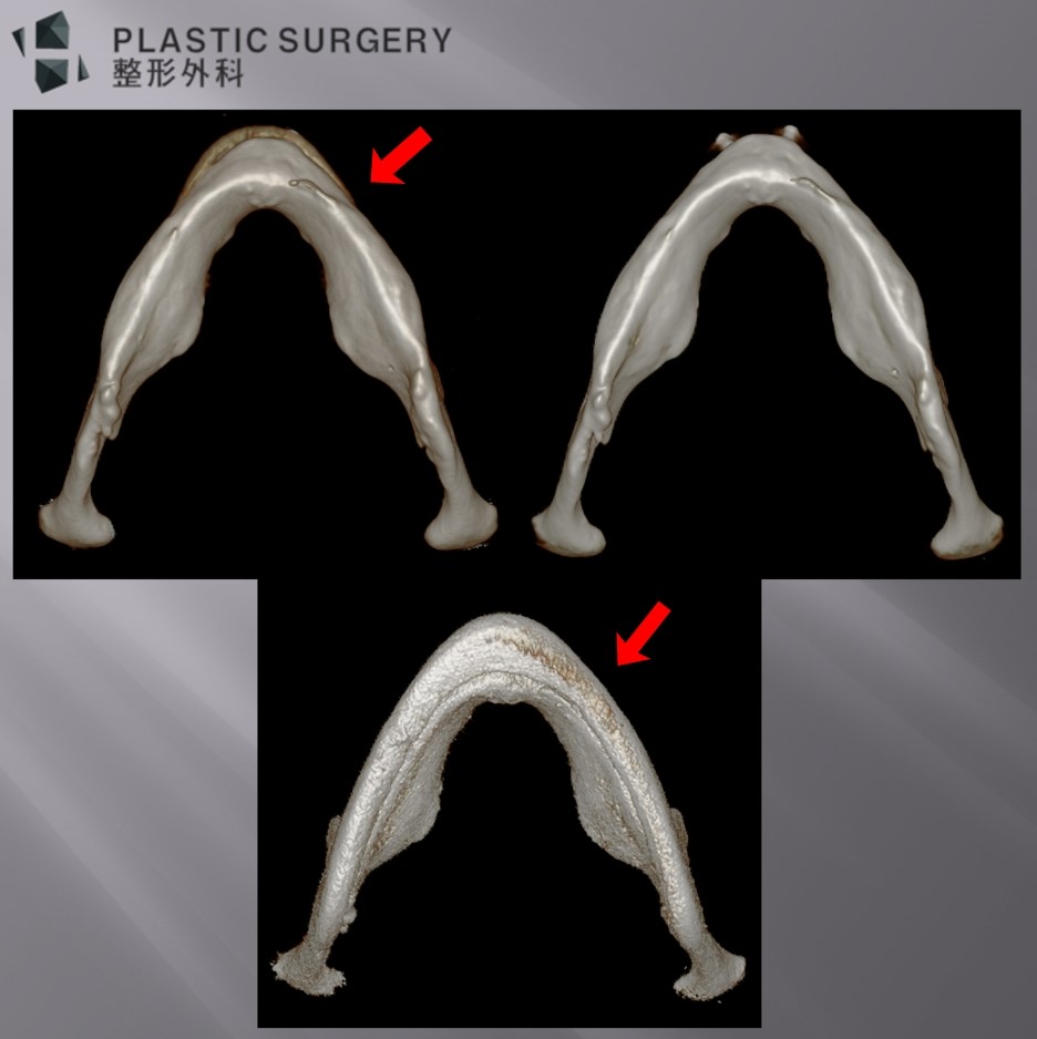 사각턱·턱끝 재건과 턱끝 보형물: 3D Fit PMMA 수술 사례 - 아래쪽에서 본 모습 입니다. 실리콘 보형물과 3D 프린터로 재작한 보형물의 차이점은