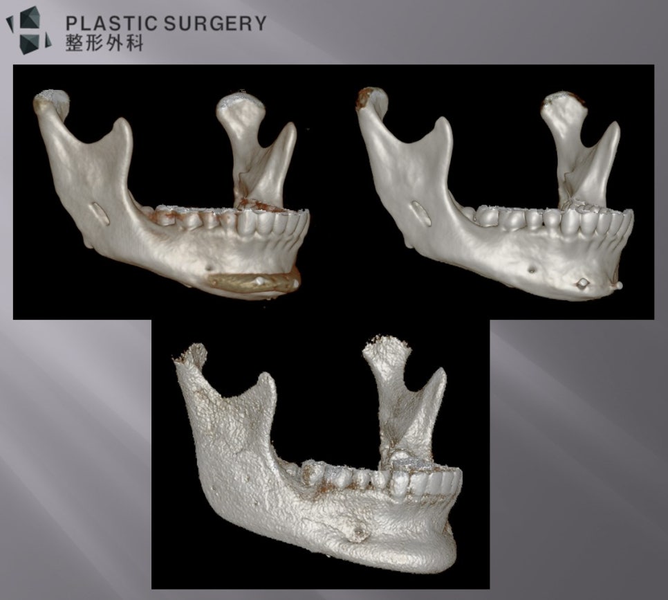 사각턱·턱끝 재건과 턱끝 보형물: 3D Fit PMMA 수술 사례 - 전체적인 모습에서도 수술 전후에서 훨씬 안정적인 사각턱의 모습을 만들 수 있는 장점이 있습니다.