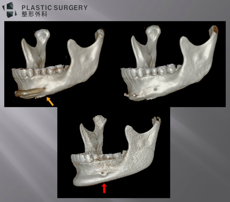 사각턱·턱끝 재건과 턱끝 보형물: 3D Fit PMMA 수술 사례 - 위 사진의 노란 화살표 부위와 같이 실리콘 보형물은 수술 후 약간의 이동, 회전이 발생할 가능성이 있기에