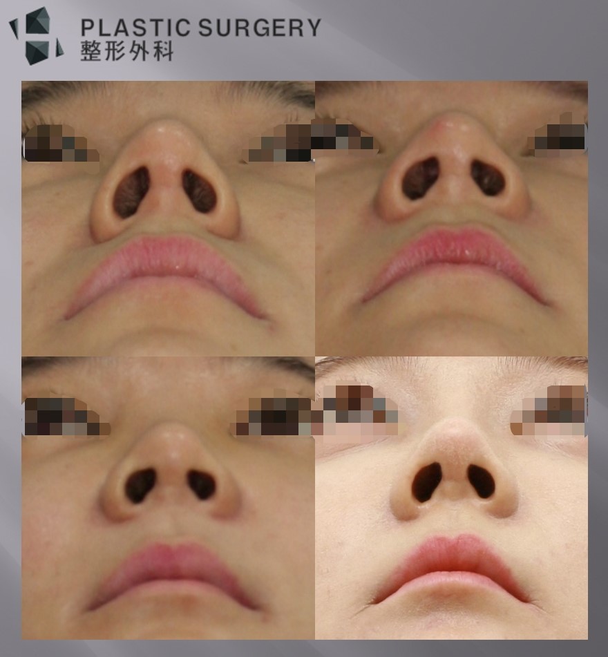 노블캣 수술 효과와 회복: 3일·16일·1년 경과 비교 - 수술 전, 수술 후 3일 수술 후 16일, 수술 후 1년 콧볼의 변화를 보기 위한 사진 입니다. 콧볼이 넓어진다?