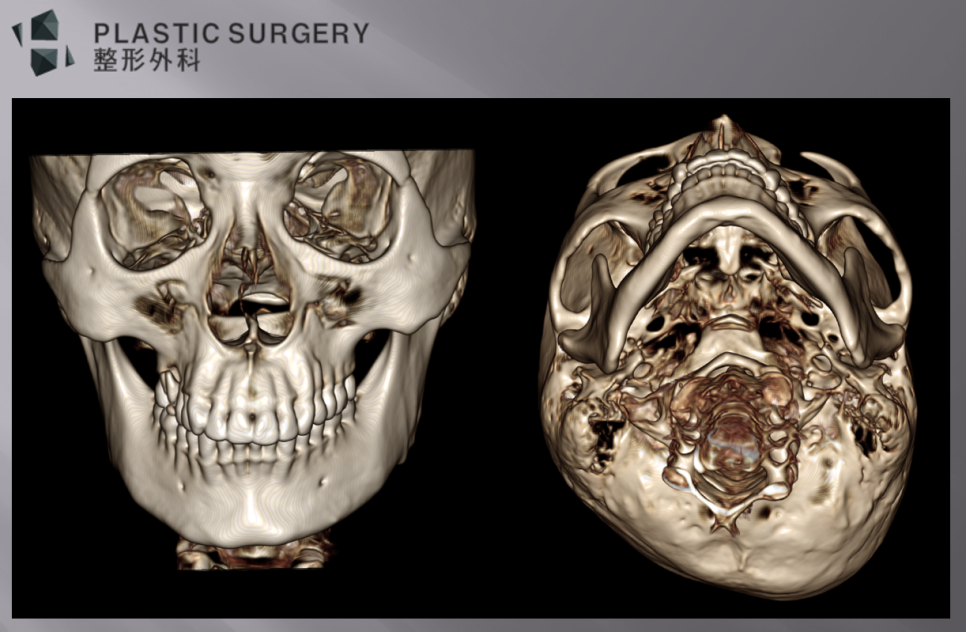 무턱과 하악왜소증의 진단: 3D CT 기반 수술 계획 - 환자의 정면 모습과 뒤통수의 모습을 보면, 오른쪽턱과 후두부가 짧은 모습을 확인할 수 있습니다.