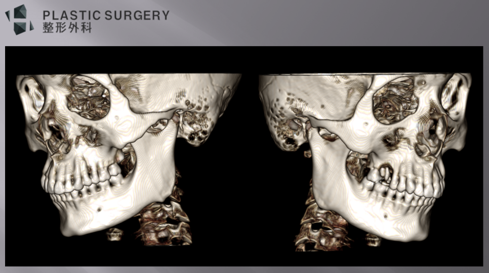 무턱과 하악왜소증의 진단: 3D CT 기반 수술 계획 - 사면 모습을 잘 비교해 보면, 우측 하악 체부의 길이가 좌측에 비해 짧은 것을 볼 수 있습니다.