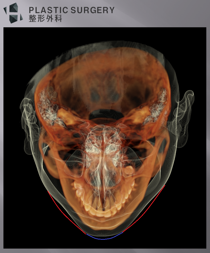 무턱과 하악왜소증의 진단: 3D CT 기반 수술 계획 - 파란색이 무턱 교정을 위한 모습이고, 빨간 선이 체부의 전진 또는 확장이
