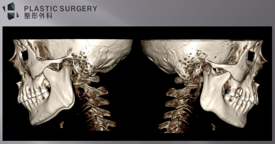 무턱과 하악왜소증의 진단: 3D CT 기반 수술 계획 - 측면 모습에서 우측 하악 체부의 앞뒤 길이가 짧고, 상하 길이는