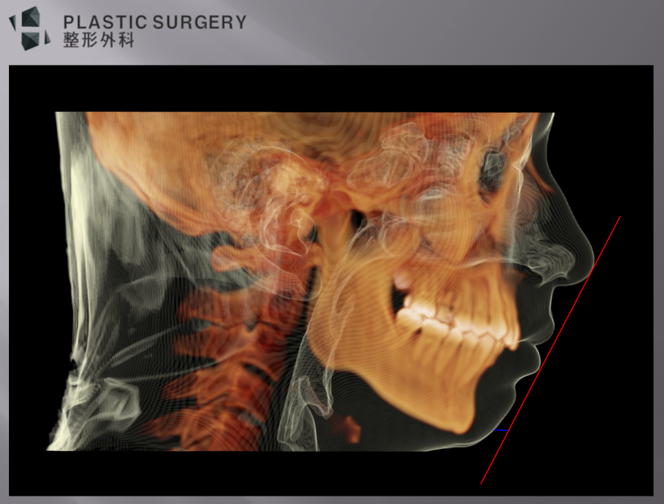 무턱과 하악왜소증의 진단: 3D CT 기반 수술 계획 - 뼈와 피부를 중첩한 이미지를 보면, 빨간 보조선에서 보듯이 턱끝의 튀어나온 정도가 부족하여,