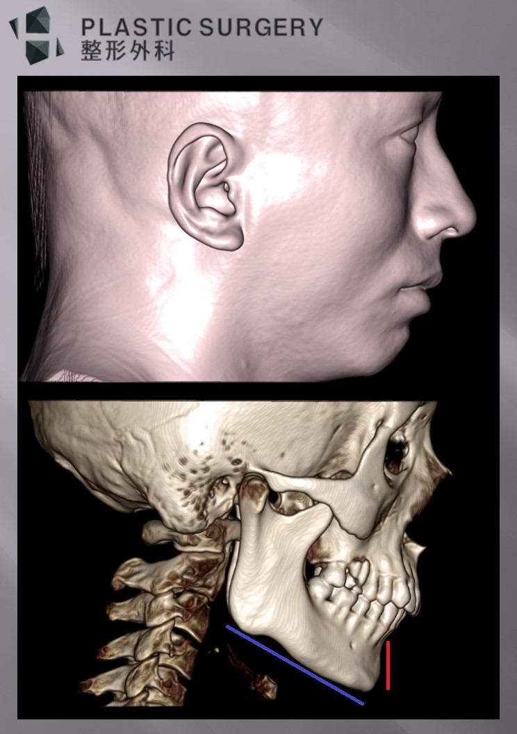 무턱과 하악왜소증의 진단: 3D CT 기반 수술 계획 - 측면 모습을 보면, 전형적인 무턱의 모습이 관찰 됩니다. 하지만, 턱의 상하 길이(빨간 선)가 짧아 일반적인 전진술로는 한계가 있고,